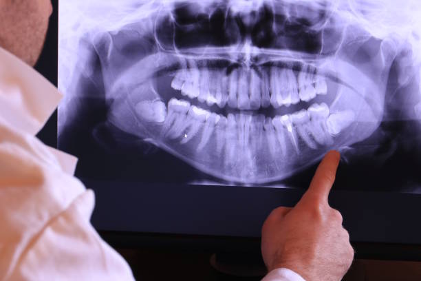 Best Emergency Wisdom Teeth Removal in Gold Bar, WA